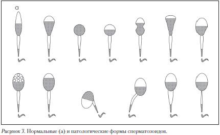 Морфология сперматозоидов по Крюгеру